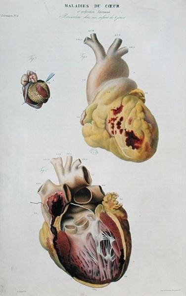 Placa retratando doenças cardíacas. Ruptura espontânea do coração de uma mulher de 86 anos (fig. 1) e pericardite num bebé de seis dias (fig. 2), de "Anatomie pathologique du corps humain" de Jean Cruveilhier (1791-1874), publicado em Paris. de Antoine Chazal