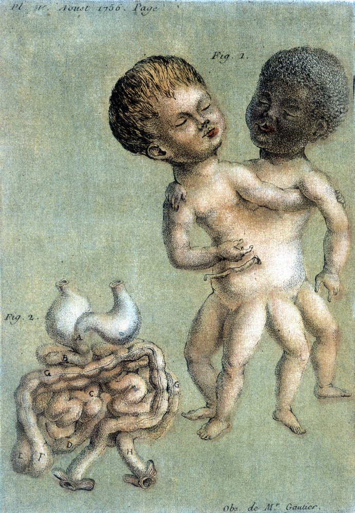 Prancha médica representando gémeos siameses: uma pessoa branca e uma pessoa negra. Ilustração de Toussaint (1756) em „Observations périodiques sur la physique, l