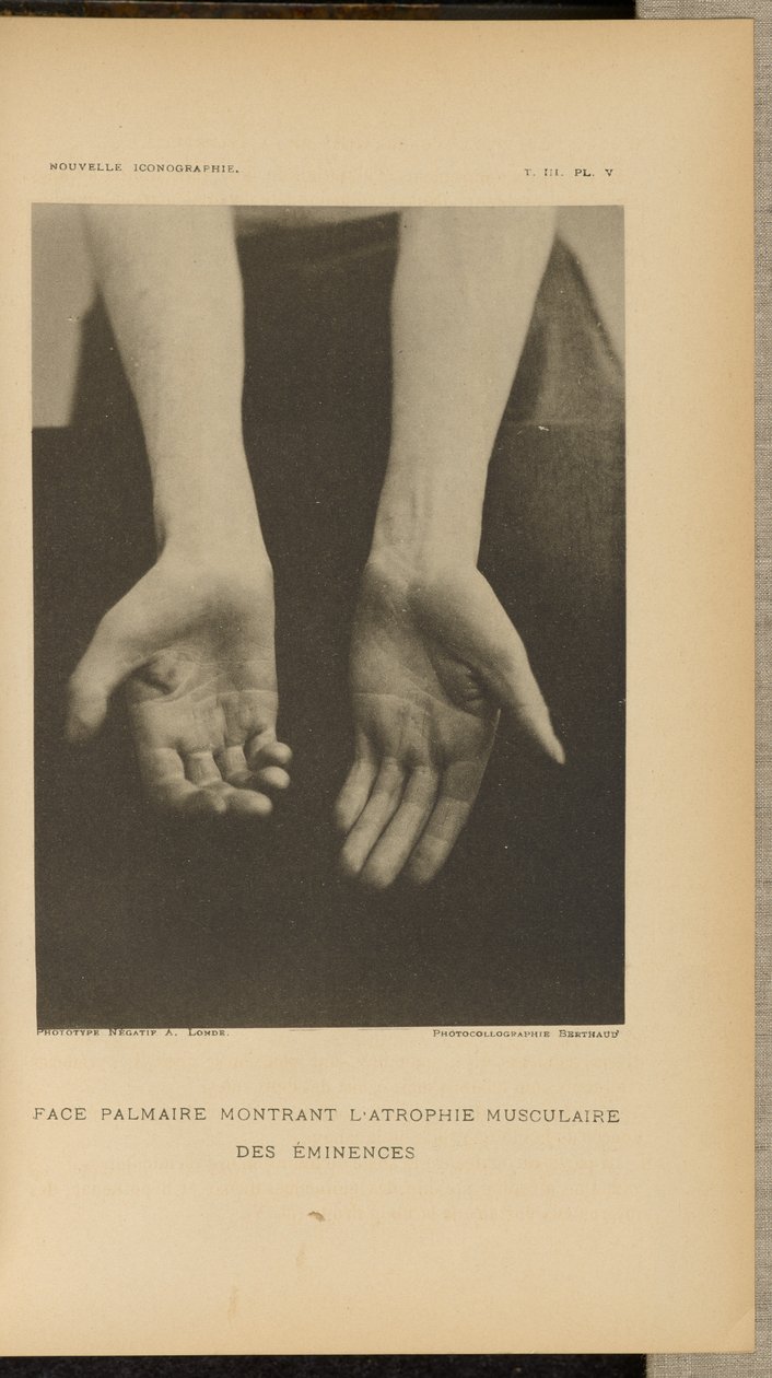 Superfície palmar com atrofia muscular das eminências de Albert Londe
