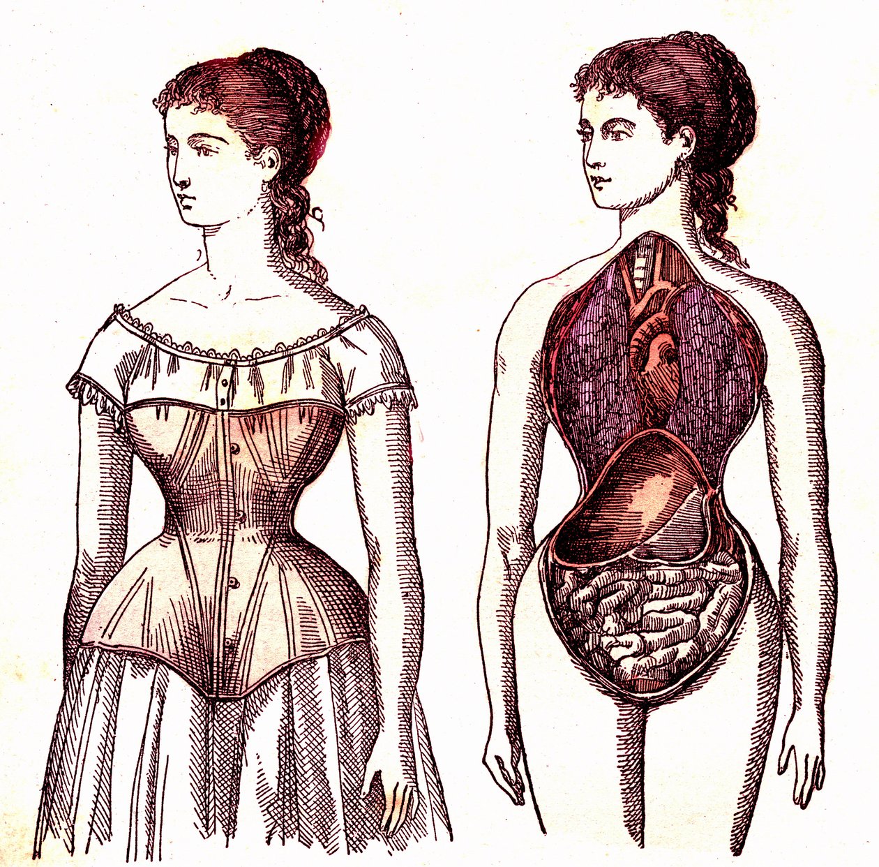 Espartilho de compressão - Vida normal e saúde por J. Rengade. Desenho de A. Demarle 1881 de Alphonse Demarle