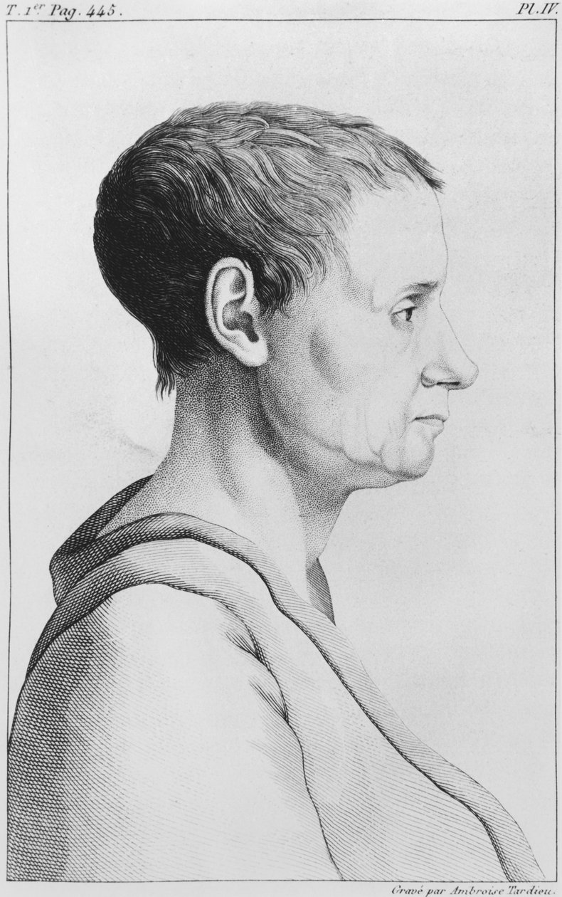 Theroigne de Mericourt, ilustração de "Doenças Mentais Consideradas Médicas, Higiênicas e Médico-Legais" por Etienne Esquirol (1772-1840), placa IV, 1838 de Ambroise Tardieu