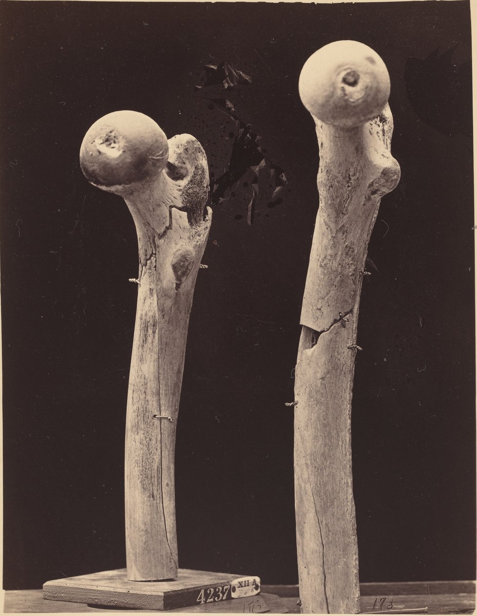 Espécimes de fraturas por arma de fogo do fêmur de American 19th Century