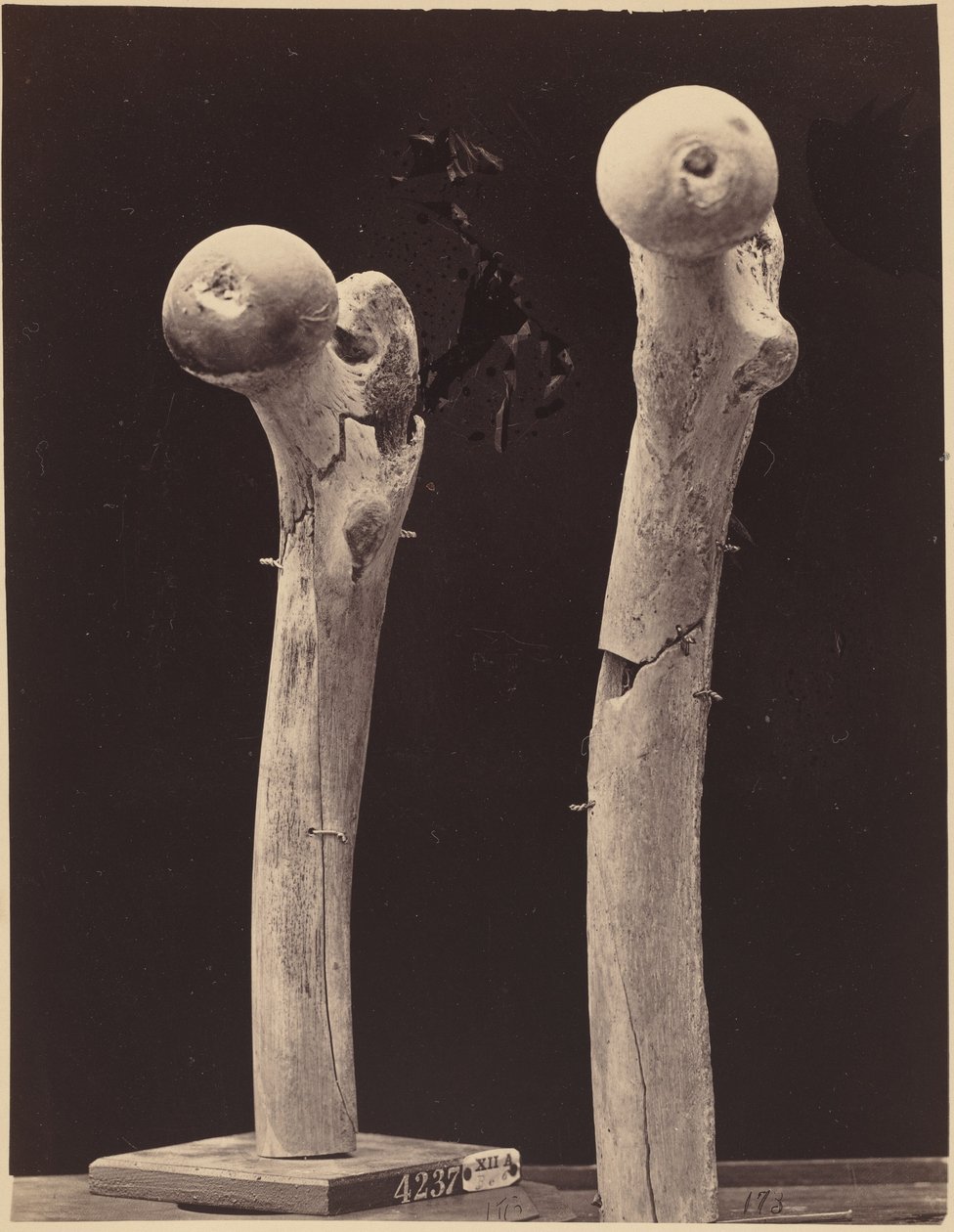 Espécimes de fracturas do fémur provocadas por arma de fogo, c. 1867 (foto) de American Photographer