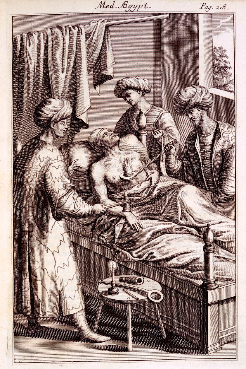 Ilustração de moxabustão de Medicina Aegyptorum por Prospero Alpinus, 1745 de American School