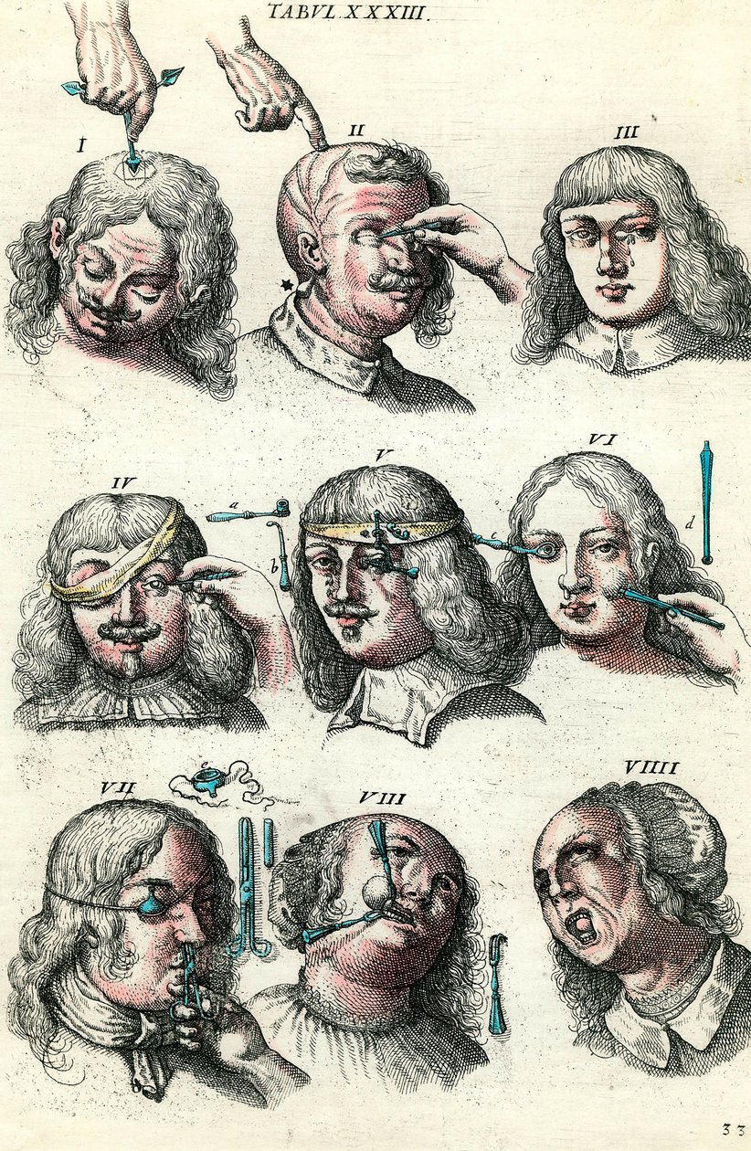 Cirurgia no século XVIII: Trepanação e operação do olho e da cara. Gravura em "Institutionis chirurgicae" de Lorenzo Heister de Anonymous Anonymous