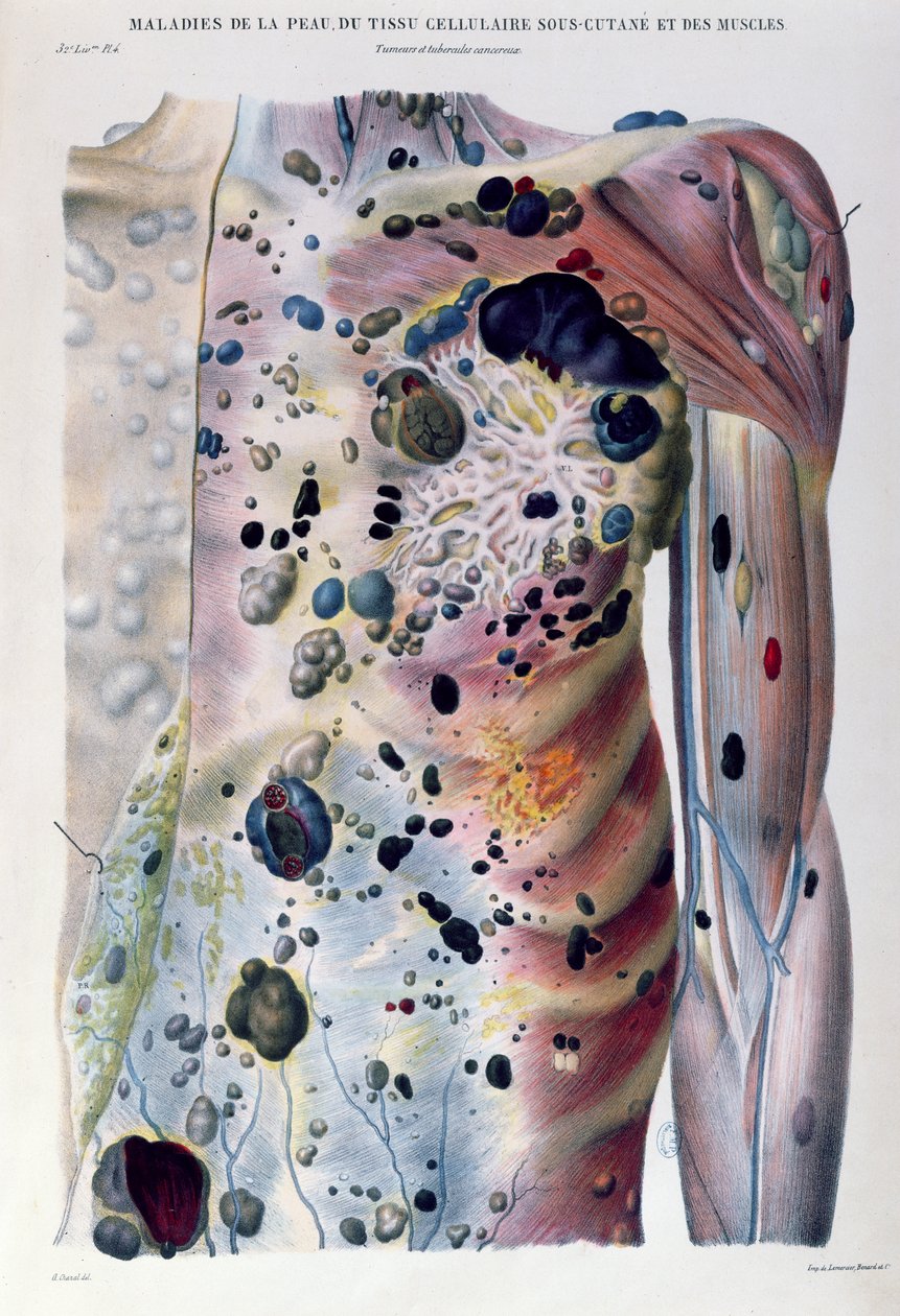 Tumores e tubérculos cancerígenos, de "Anatomia Patológica do Corpo Humano" por Jean Cruveilhier (1791-1874) 1828-42 de Antoine Chazal