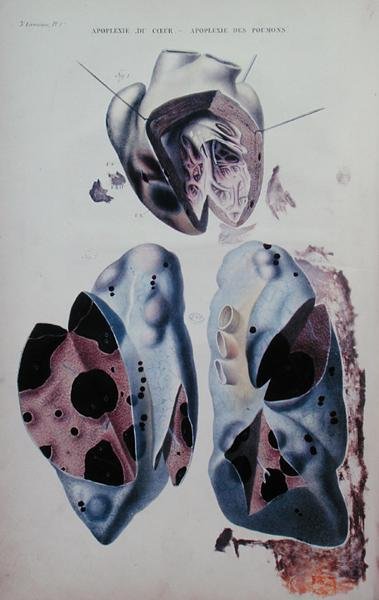 Apoplexia do coração e dos pulmões, placa ilustrativa de "Anatomie pathologique du corps humain" de Jean Cruveilhier (1791-1874), publicado em Paris de Antoine Chazal