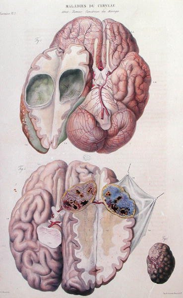 Tumores cancerosos do cérebro, de "Anatomie Pathologique du Corps Humain" de Jean Cruveilhier (1791-1874) 1828-42 (gravura colorida) de Antoine Chazal