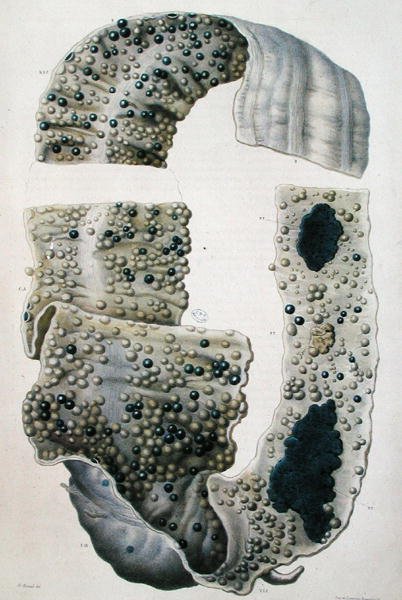 Doenças dos intestinos, de "Anatomie Pathologique du Corps Humain" de Jean Cruveilhier (1791-1874) 1828-42 (gravura colorida) de Antoine Chazal