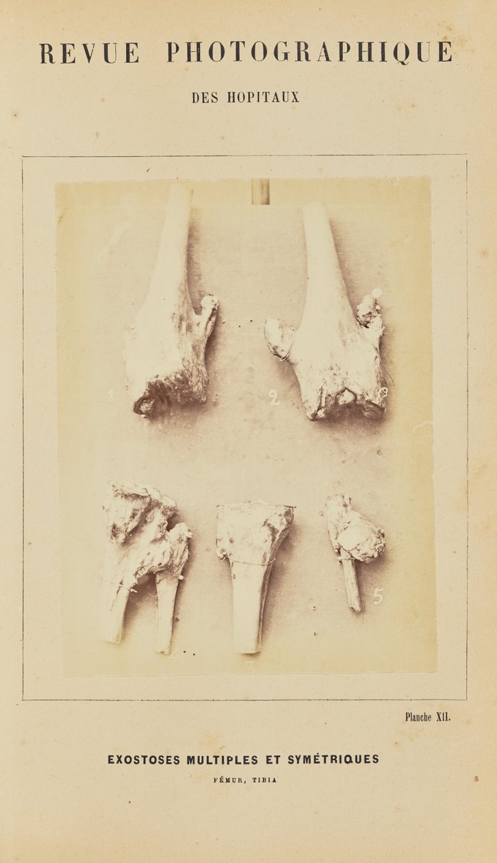 Exostoses simétricas múltiplas, fémur, tíbia de Arthur de Montmeja
