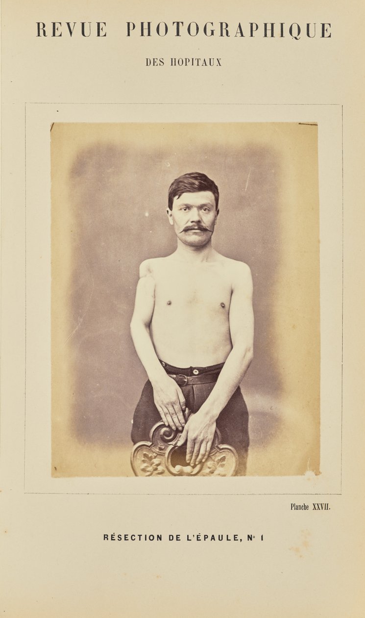 Ressecção do ombro, número 1 de Arthur de Montmeja