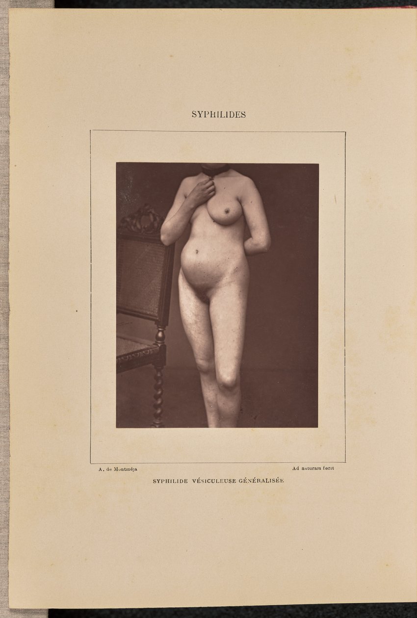 Sífilis vesicular generalizada de Arthur de Montmeja