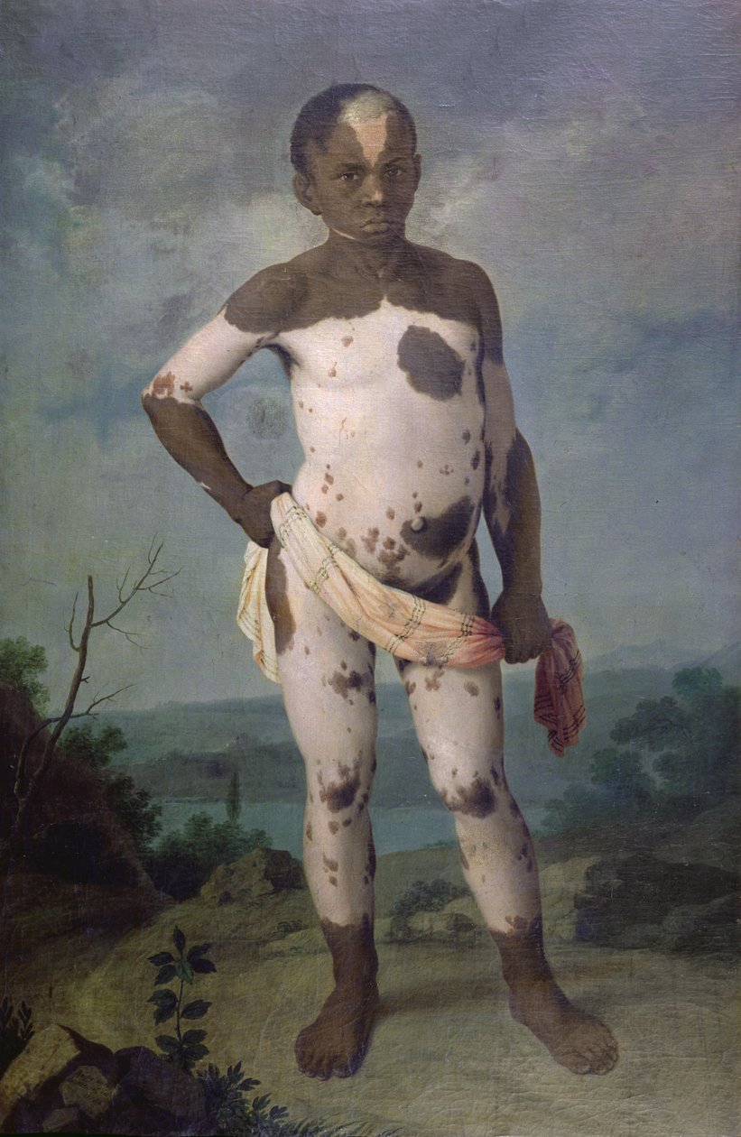 Criança com Vitiligo, 1786 de Brazilian School