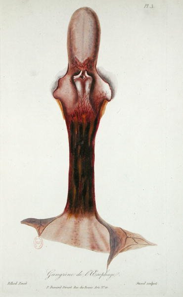 Gangrena do esófago, de 