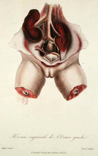 Hérnia inguinal do ovário esquerdo, de 
