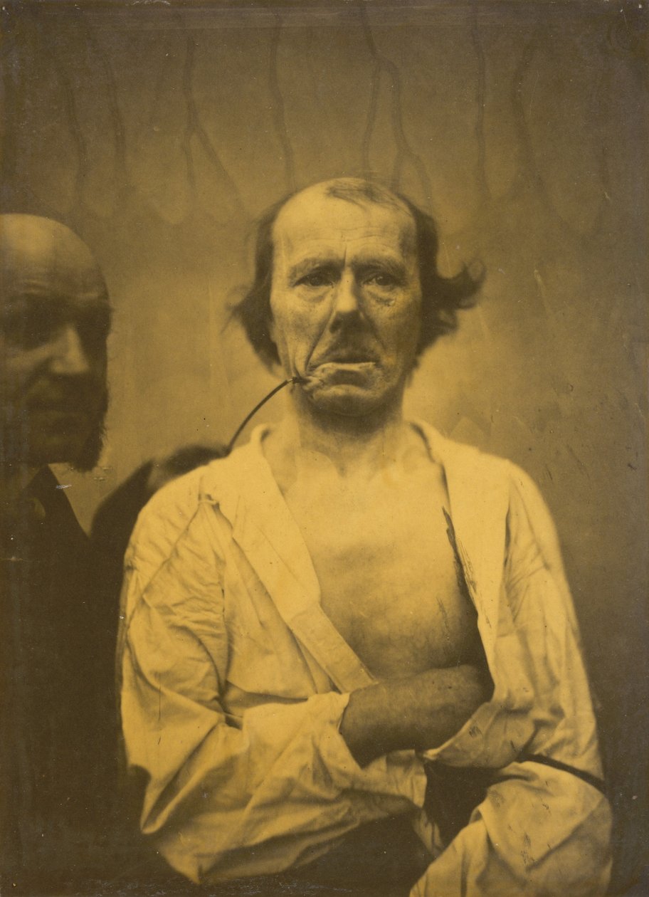Uma expressão relaxada à esquerda, Disgust right, 1854-1856, impresso em 1862. de Duchenne de Boulogne