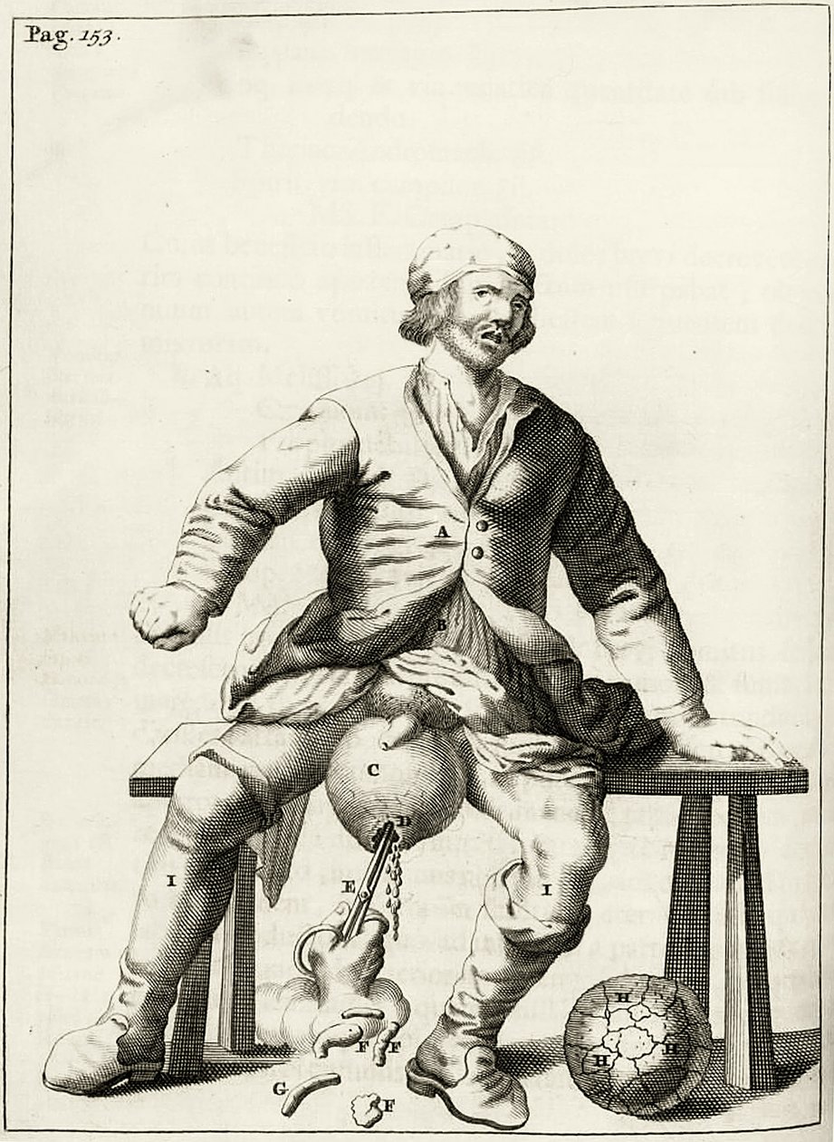 Drenagem do fluido do Hidrocelo do escroto, a partir dos exercícios práticos para curar método por Frederic Dekkers, 1694 de Dutch School