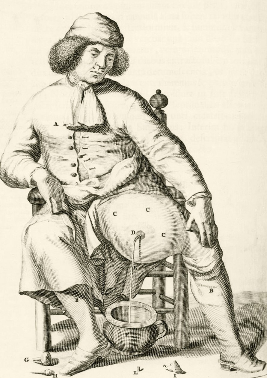 Drenagem do fluido a partir de um abcesso, a partir dos exercícios práticos para curar método por Frederic Dekkers, 1694 de Dutch School