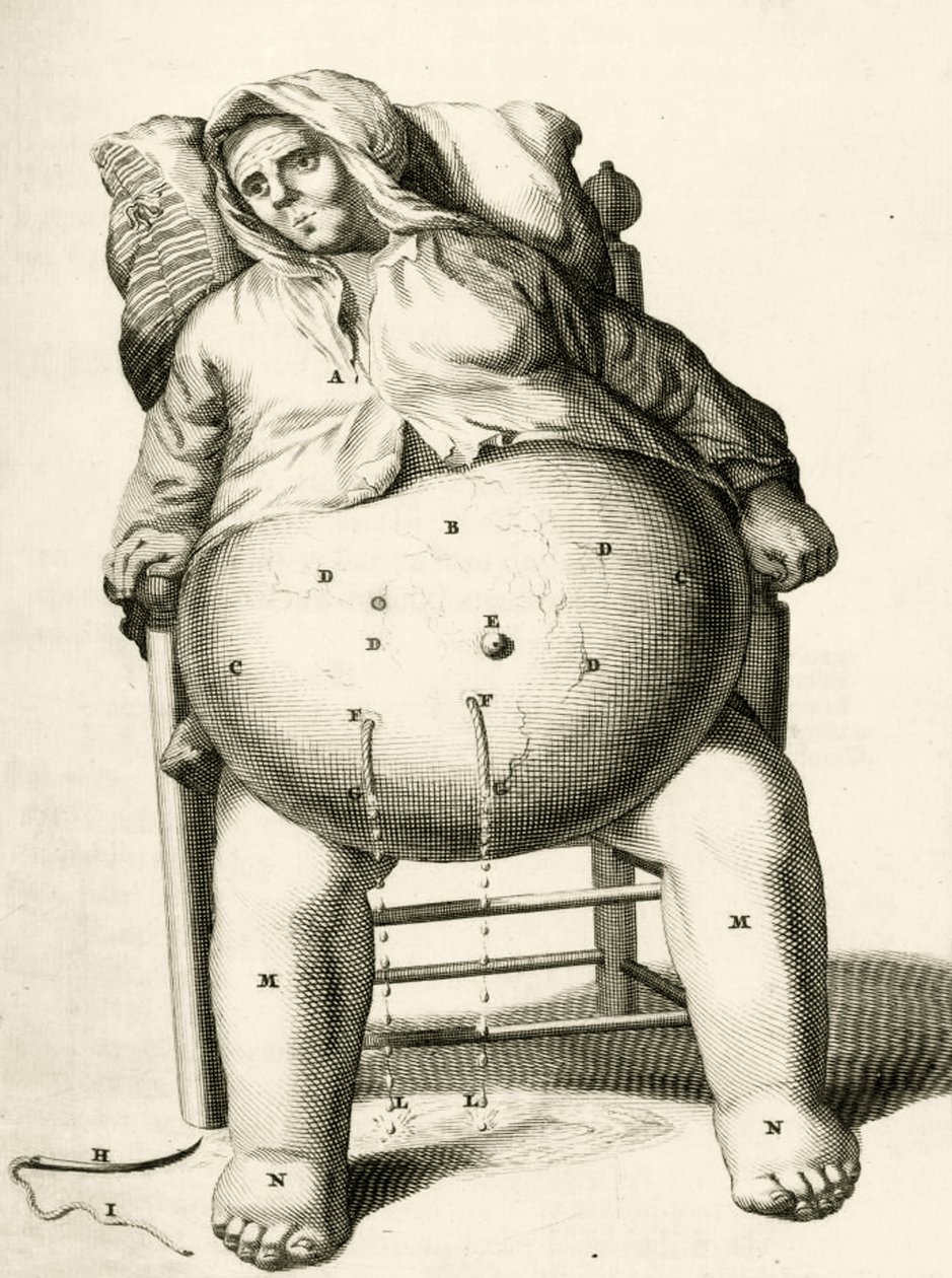 Drenagem do fluido a partir de um abcesso, a partir dos exercícios práticos para curar método por Frederic Dekkers, 1694 de Dutch School