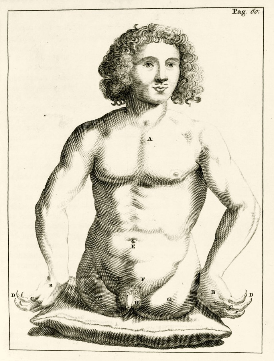 Exemplo de defeitos congénitos congénitas, a partir dos exercícios práticos para curar método por Frederic Dekkers, 1694 de Dutch School