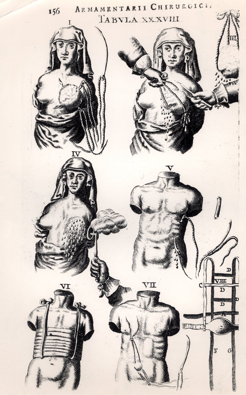 Operando no câncer de mama, de Armamentarii Chirurgici, de Johannes Schultes (1595-1645), publicado em Amsterdã, 1672 de Dutch School