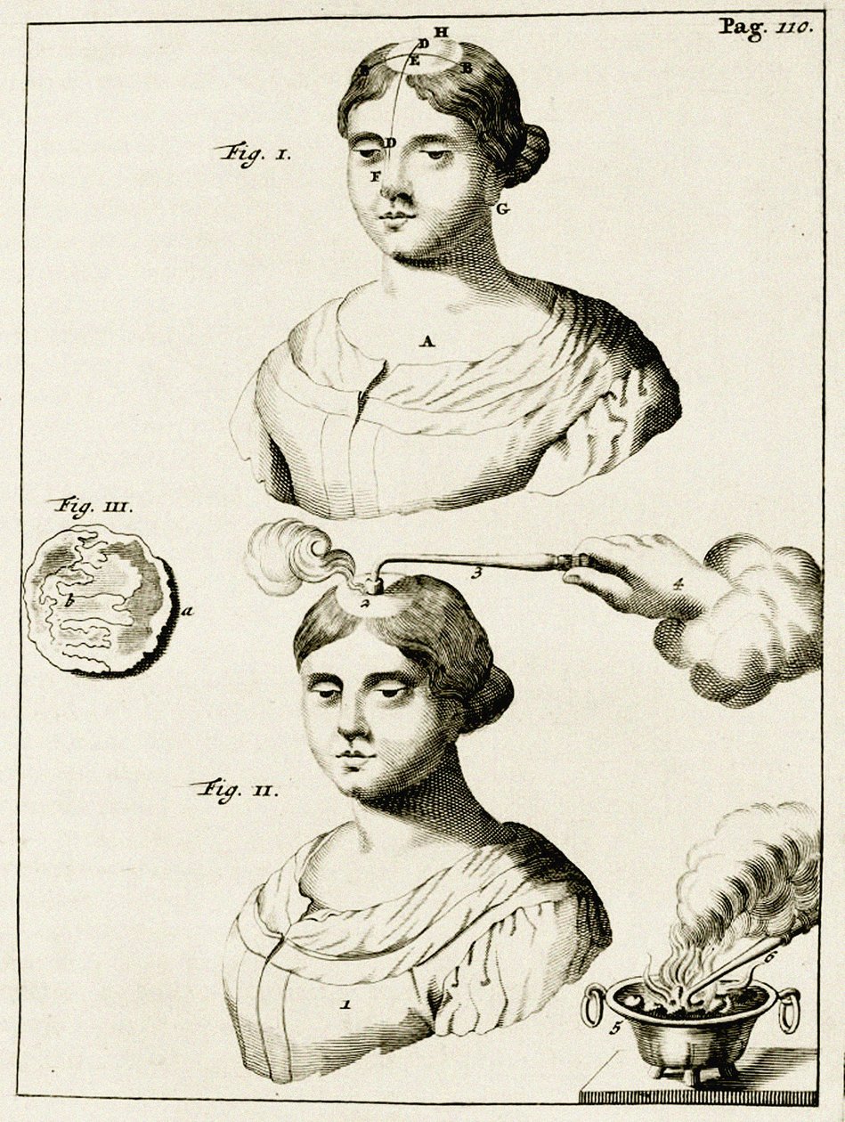 Tratar um doente de epilepsia, a partir dos exercícios práticos para curar método pelo Frederic Dekkers, 1694 de Dutch School