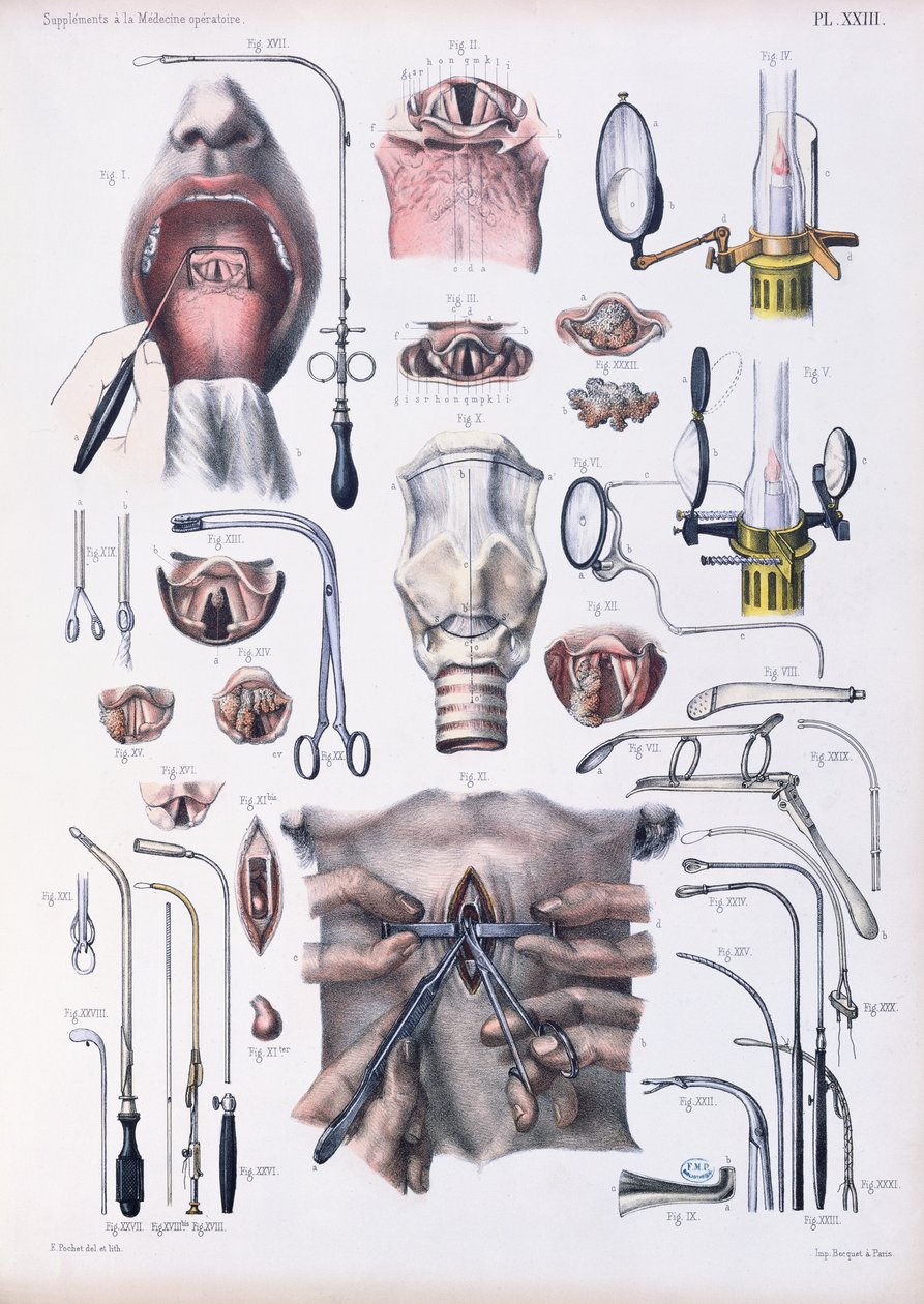 Operação de traqueotomia, placa de "Tratado Completo sobre a Anatomia do Homem" por Jean-Baptiste Marc Bourgery (1797-1849) 1866-67 de E. Pochet