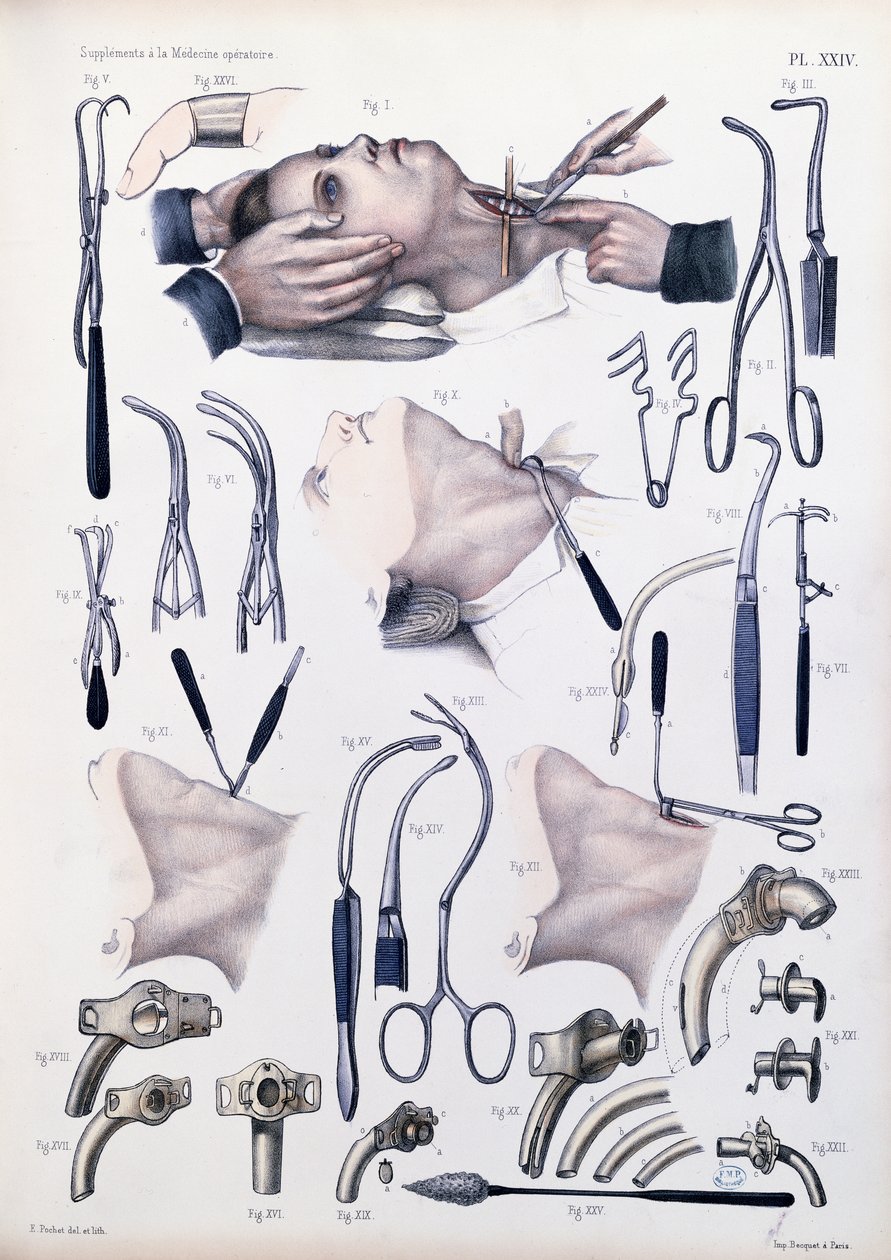 Operação de traqueotomia, placa de "Tratado Completo sobre a Anatomia do Homem" por Jean-Baptiste Marc Bourgery (1797-1849) 1866-67 de E. Pochet