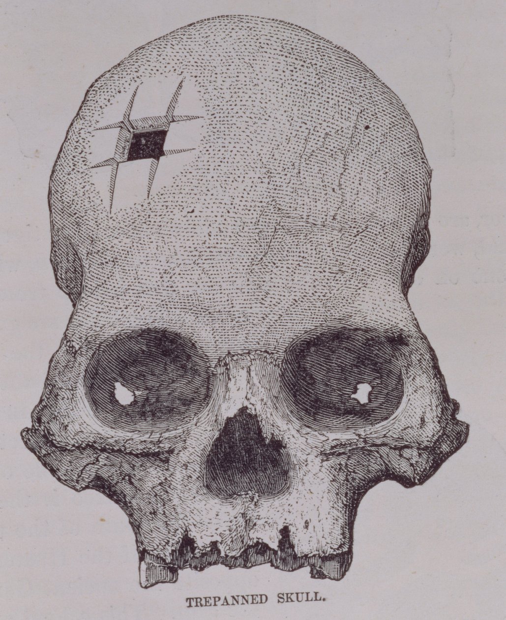 Crânio Trepanado, de "Incidentes de Viagem e Exploração na Terra dos Incas", de E. George Squier, pub. em 1878 de English School