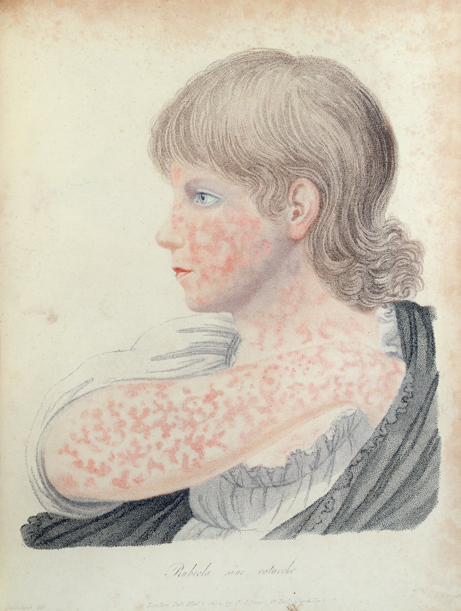 Sarampo alemão, ilustração para um livro de Robert Willan (1757-1812), 1808 (gravura a cores) de English School