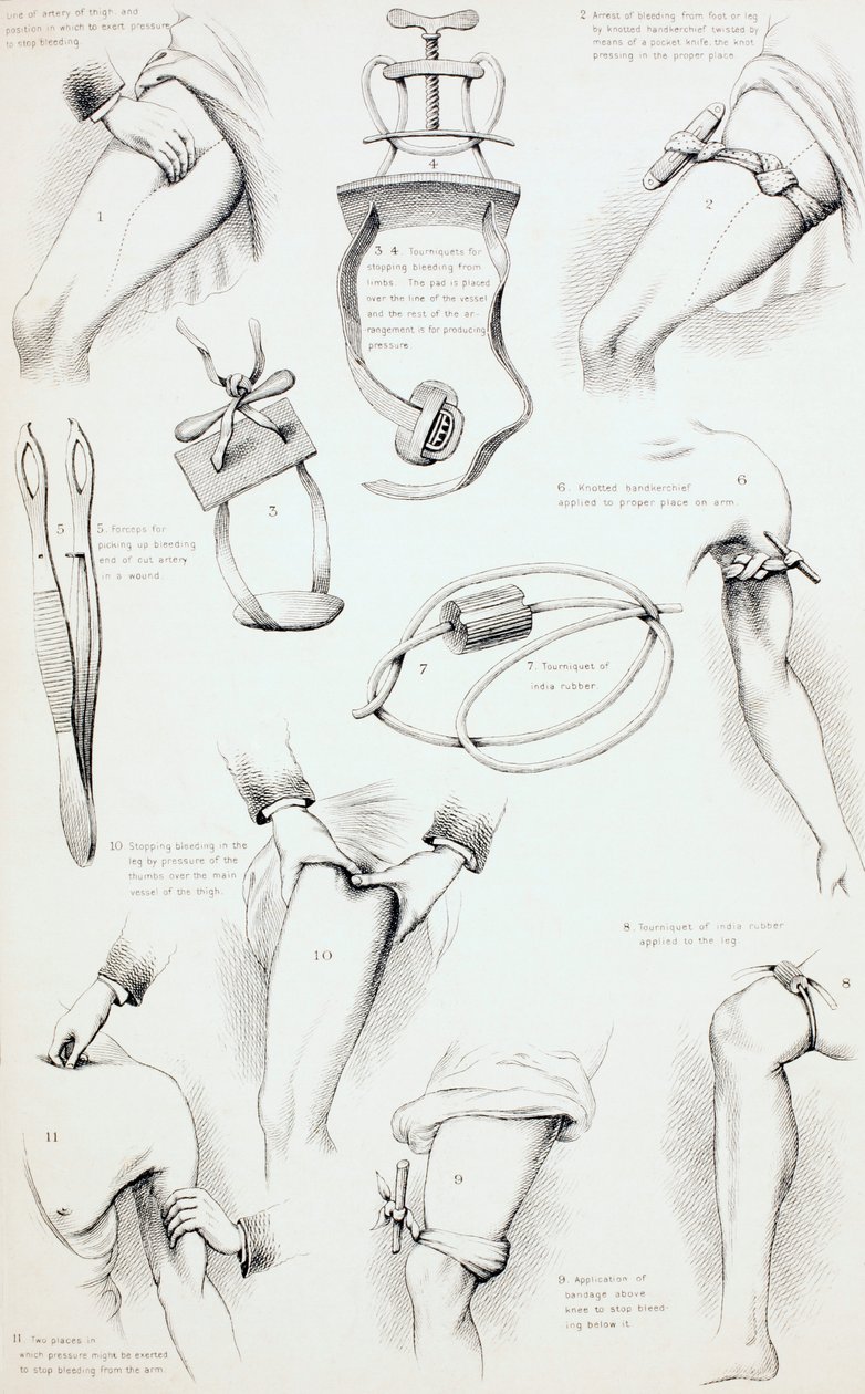 Métodos de Prisão Sangrar, c.1890 de English School