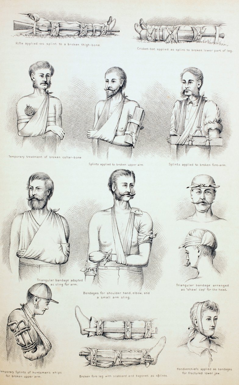 Tratamento Temporário de Fraturas, c.1890 de English School