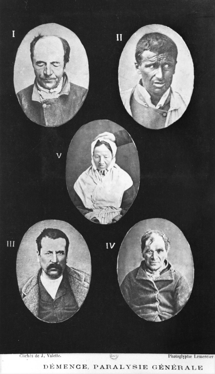 Demência, Paralisia Geral, ilustração do Novo Tráfico Primário e Prático em Doenças Mentais por Henri Dagonet (1823-1902) Paris, Bailliere, 1876 de French Photographer