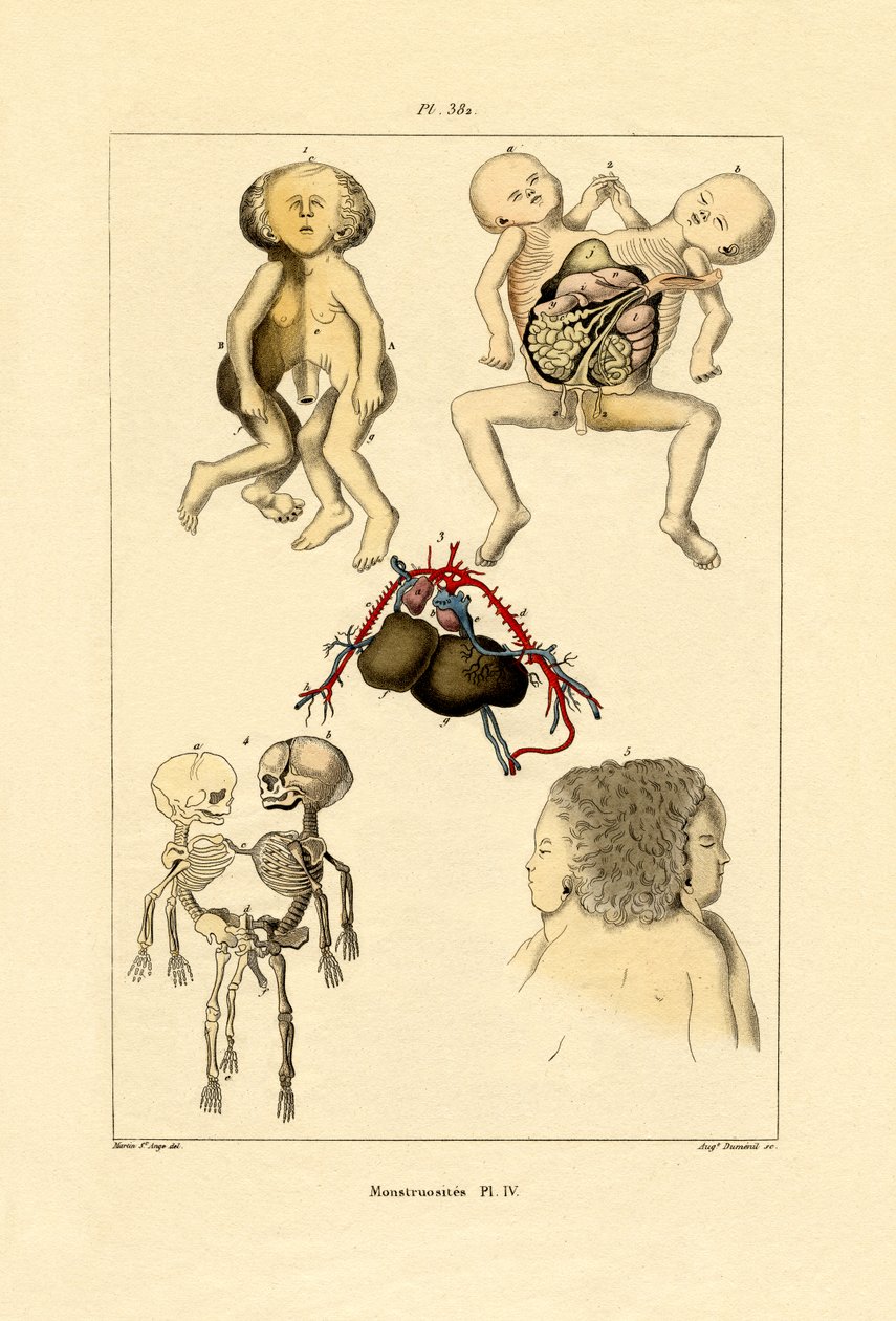 Anormal, 1833-39 de French School