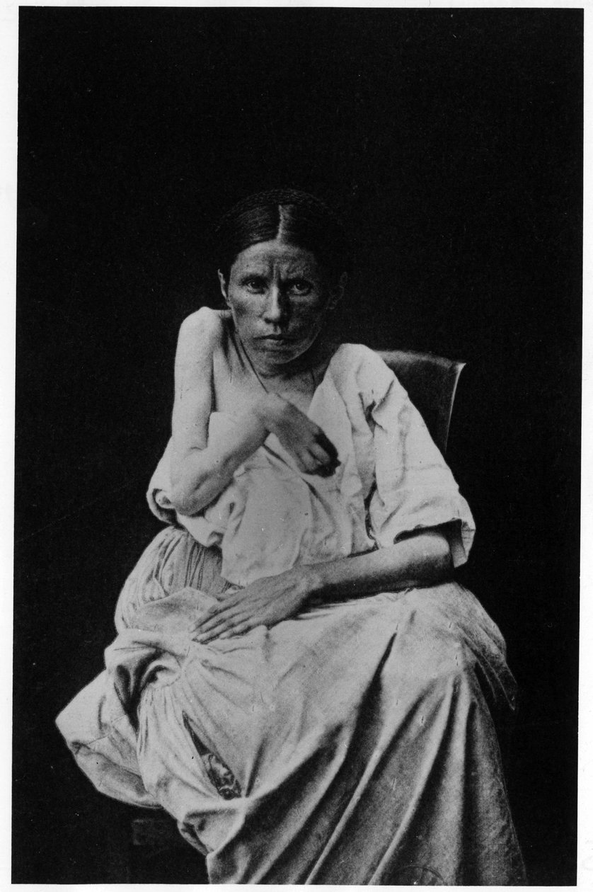 Fotografia de um paciente que sofre de epilepsia hemiplégica, -in "fotografia iconográfica do Salpetrière, Bourneville e P. Regnard, Paris de French Photographer