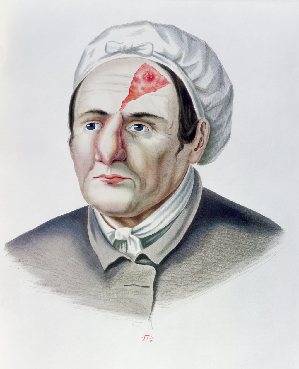 Após uma operação de enxerto de pele, da Selecta Praxis Medico-Chirurgica por Alexander Auvert, Paris, 1856 de French School