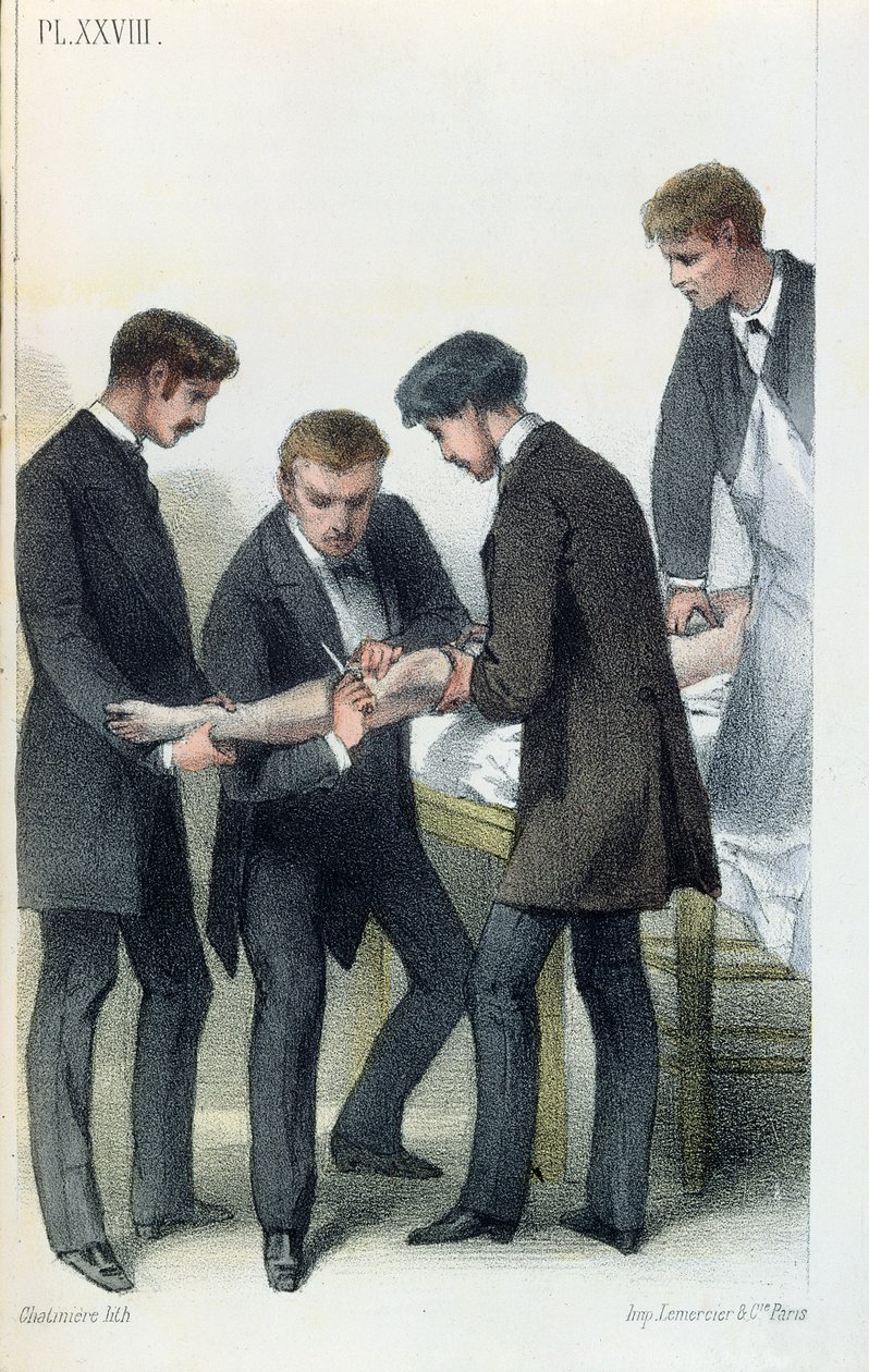 Amputando um braço, de um manual médico por Jean-Baptiste-Leon Dubreuil, c.1850-60 de French School