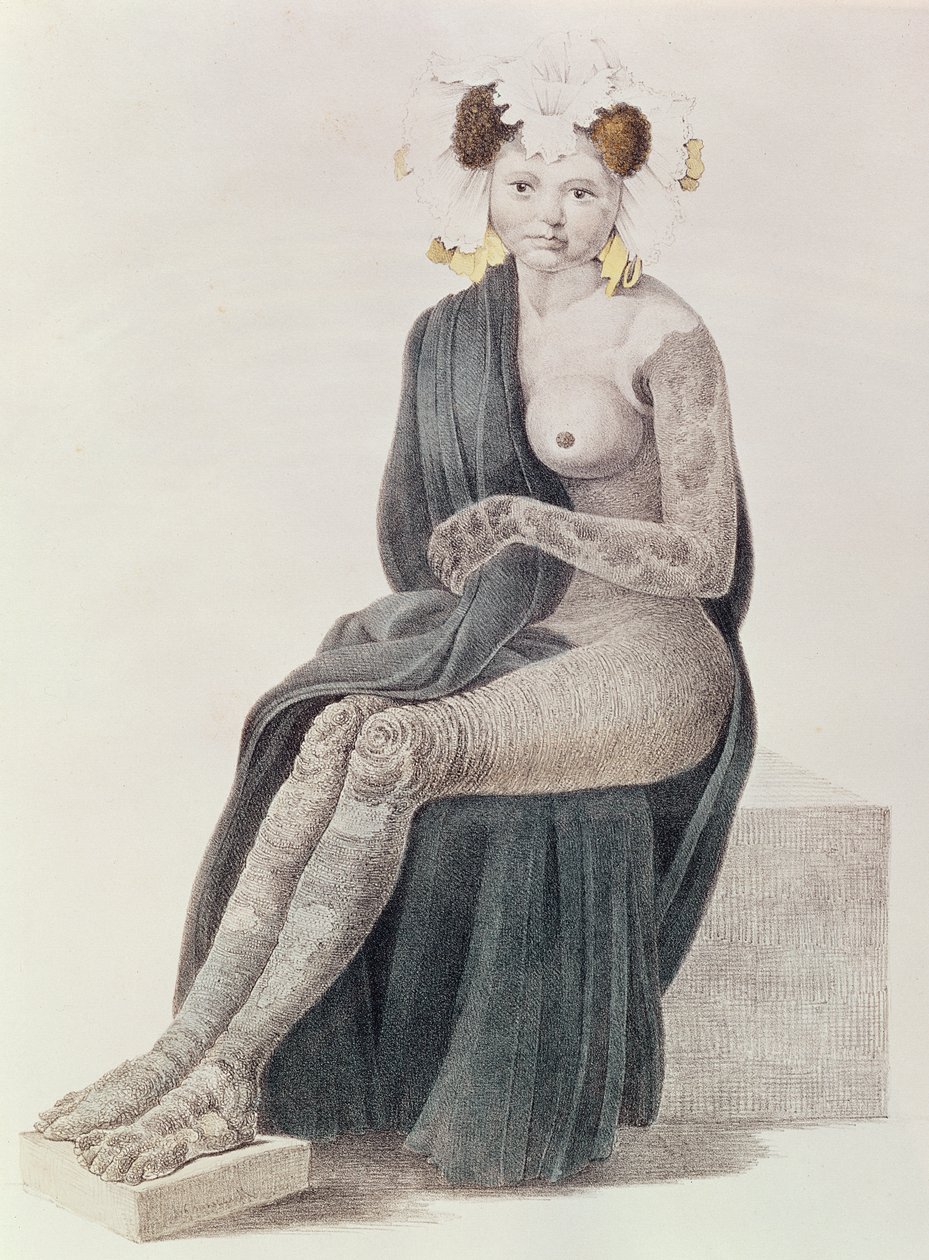 Ictiose congênita, de um livro de GM Olbers, 1830 de French School