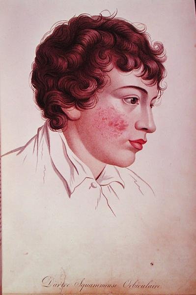 Pensos secos, de "Description des Maladies de la Peau" do Barão Jean Louis Alibert (1768-1837) de French School