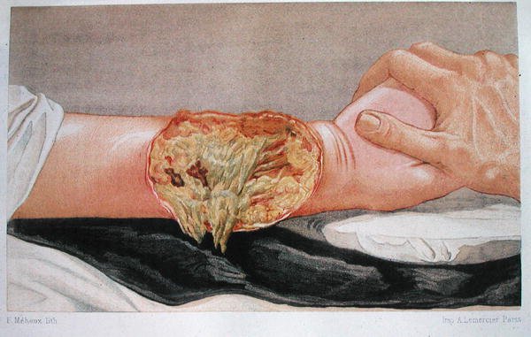 Gangrena do Hospital, de 