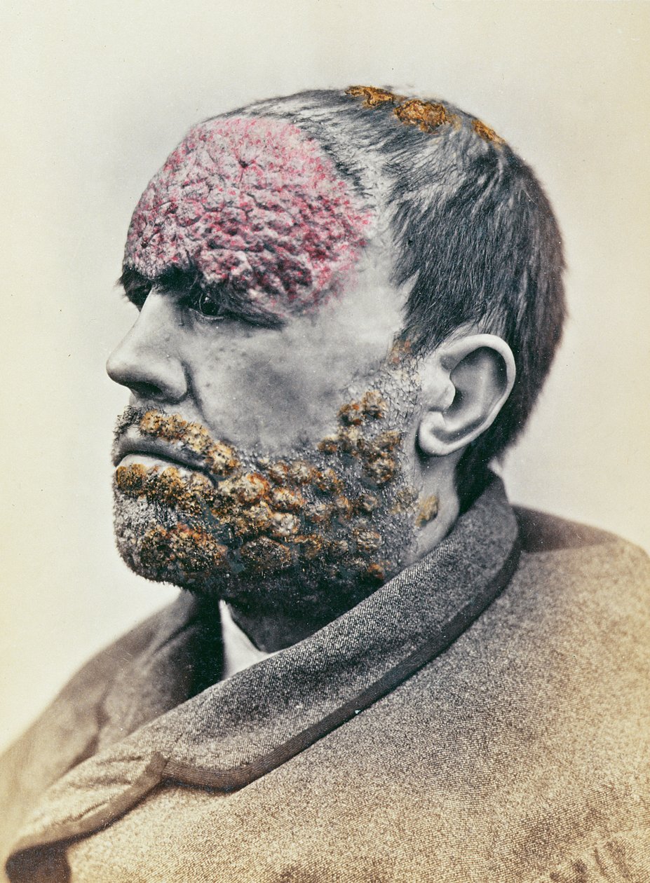 Homem, sofrimento, sífilis, de, um, fotografia, levado, para, a, Clinique, Photographique, de, lopopital, Saint-Louis, 1868 de French School