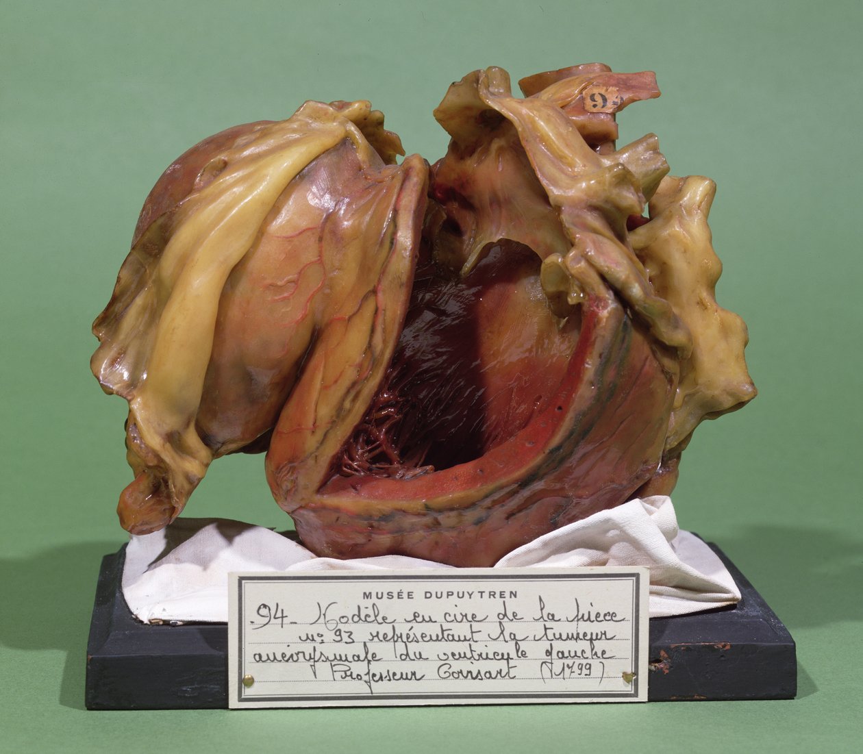 Modelo de um tumor do ventrículo esquerdo, 1799 (cera) de French School