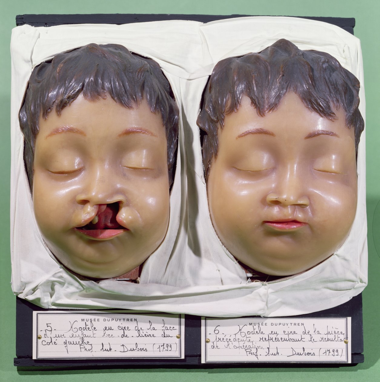 Modelo mostrando o rosto de uma criança antes e depois de uma operação para corrigir uma lipoide realizada por Antoine Dubois (1756-1837) em 1799 (cera) de French School