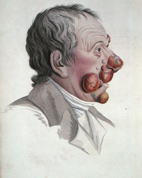 Mycosis Fongoide, de um livro do Barão Jean Louis Alibert (1768-1837) 1838 (gravura a cores) de French School