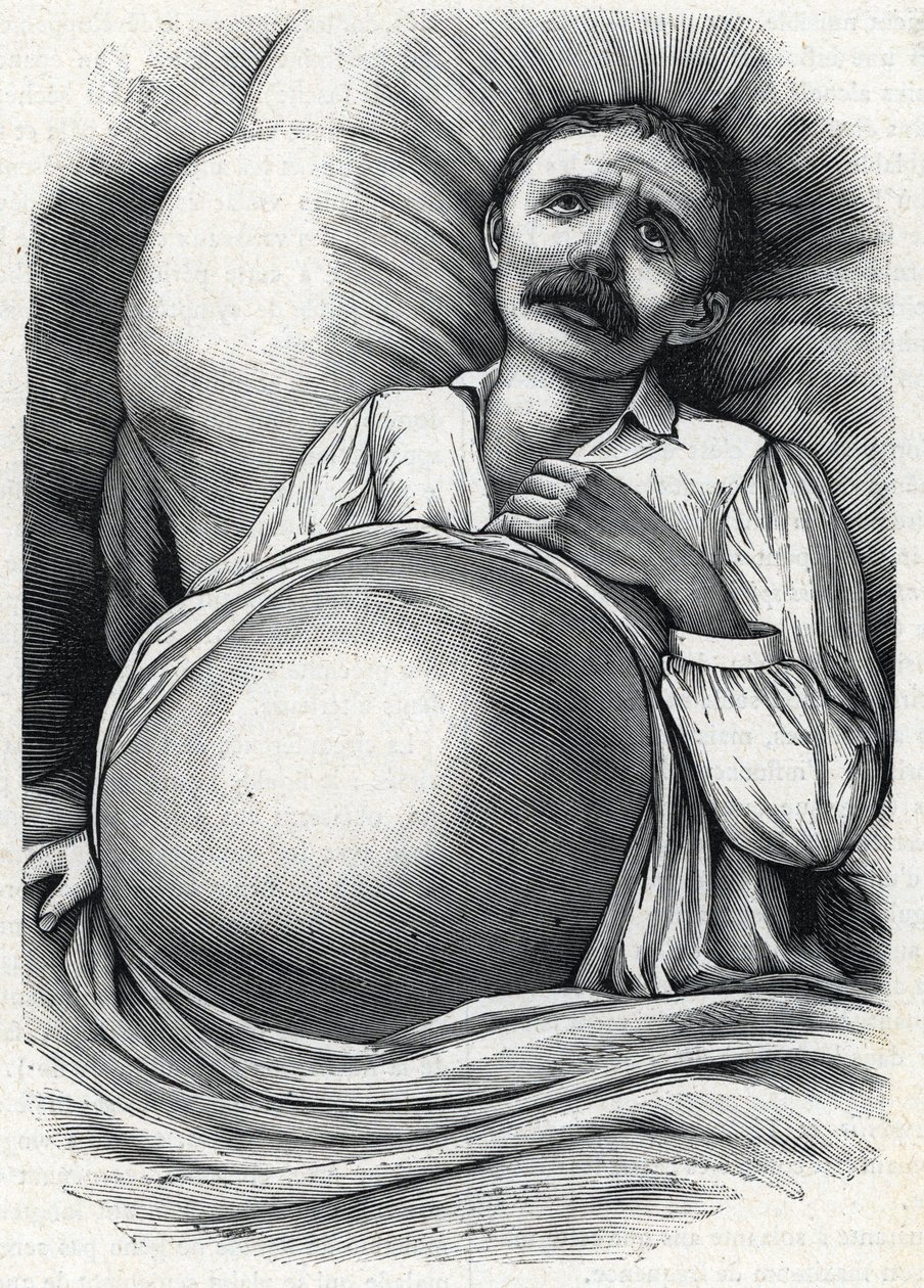 Paciente com cirrose hepática avançada (gravura) 1888 de French School