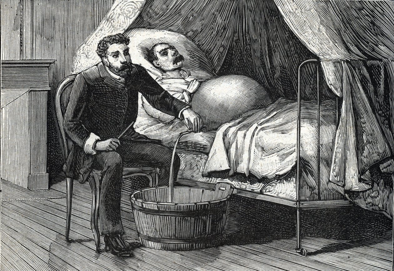 Paciente com cirrose hepática avançada, médico realizando uma punção (gravura) 1888 de French School