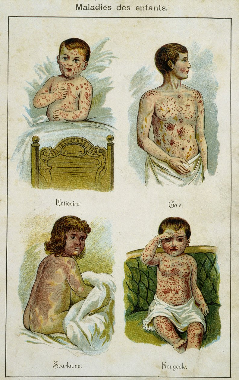 Placa ilustrativa de doenças infantis: urticária, sarna, escarlatina e sarampo (puxados de Bilz, medicação natural) no final do século XIX. de French School