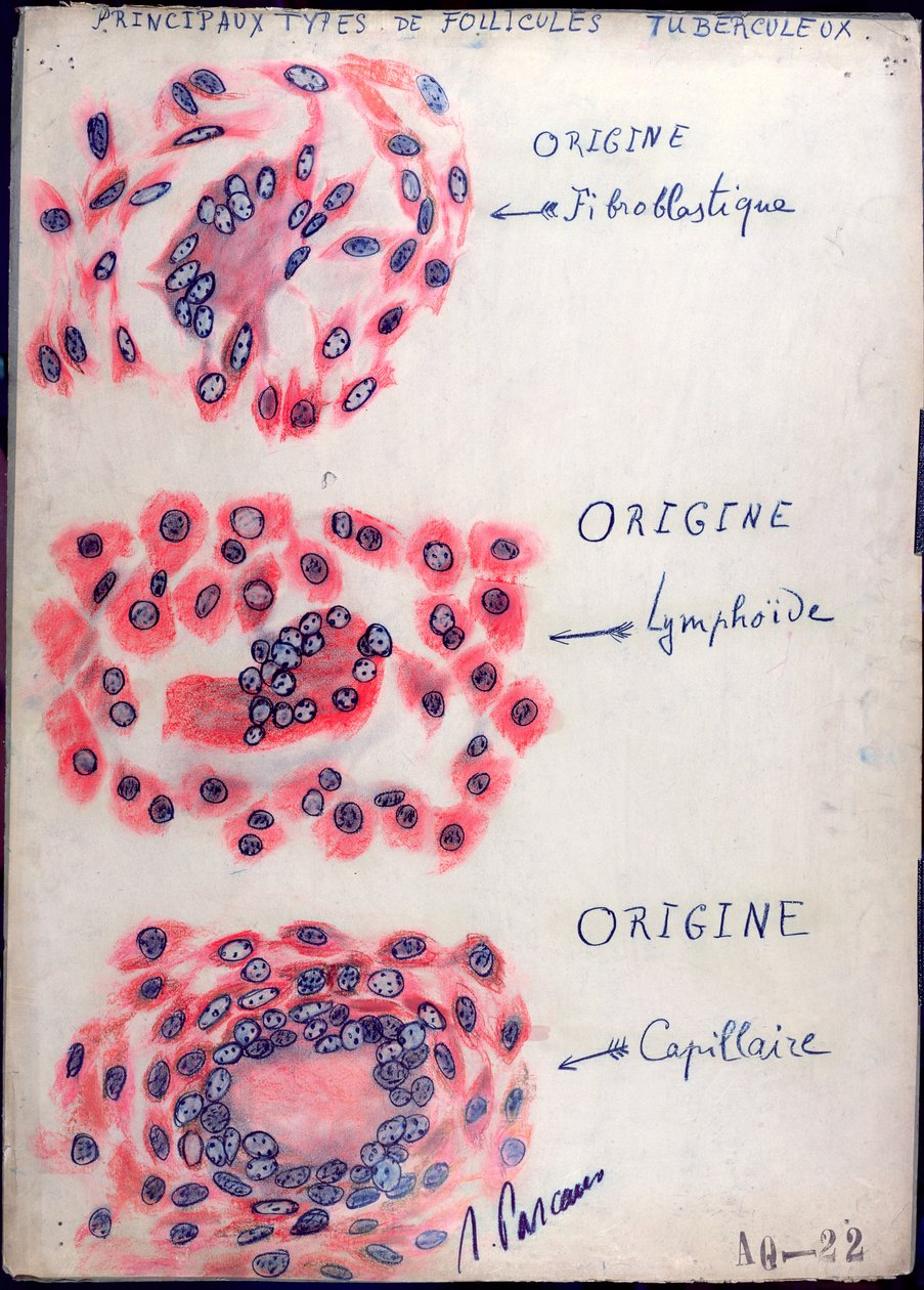 Princípio dos folículos da tuberculose de French School