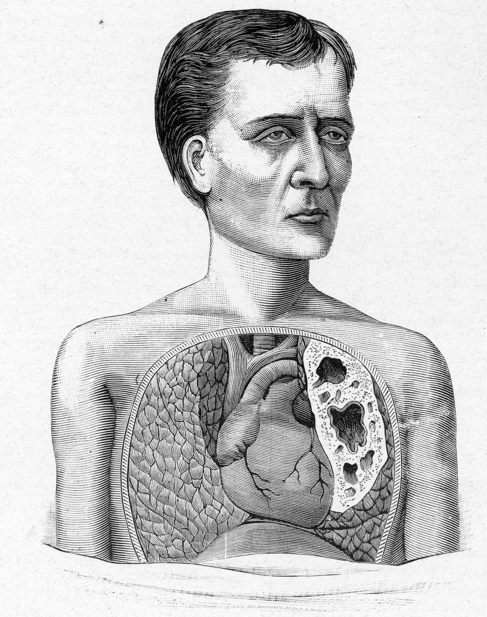 Representação de uma pessoa com grutas, complicação da tuberculose (gravura) de French School