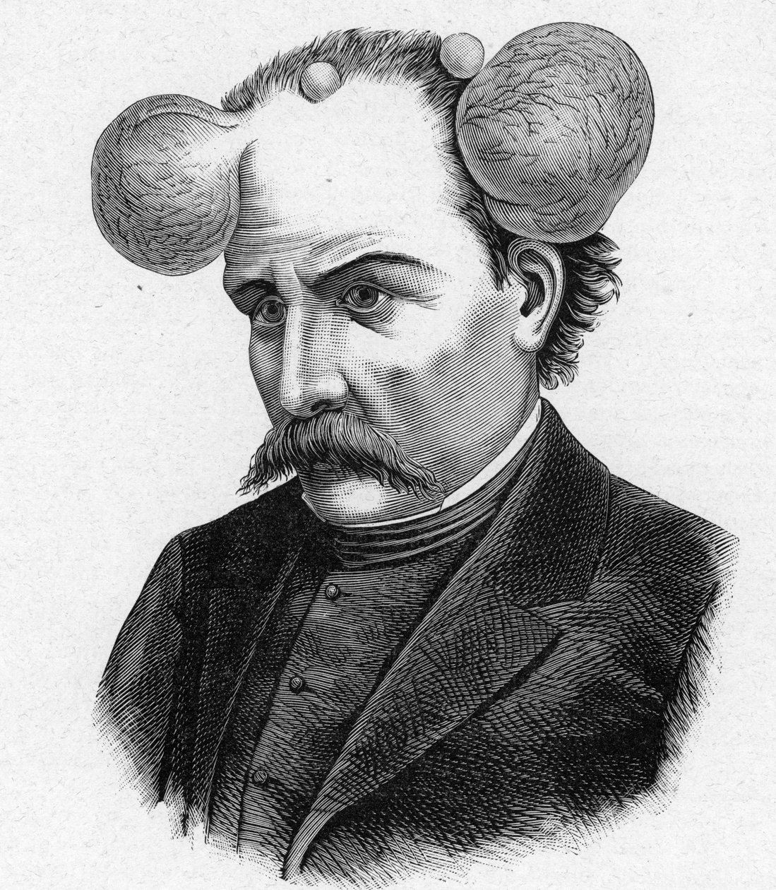Representação de uma pessoa com lupa, quistos de escalpe (gravura) de French School